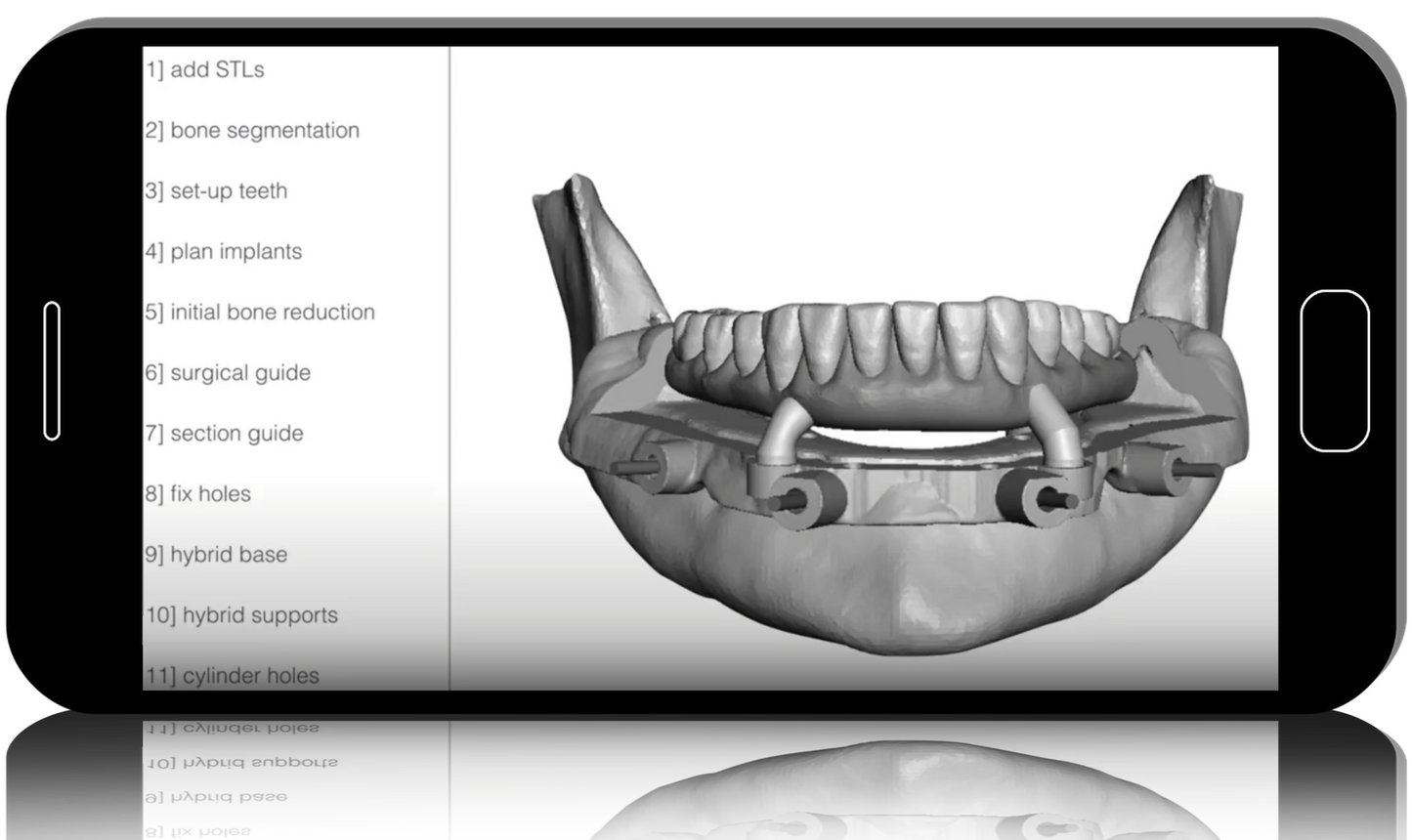 Advanced Surgical Guides - All on X