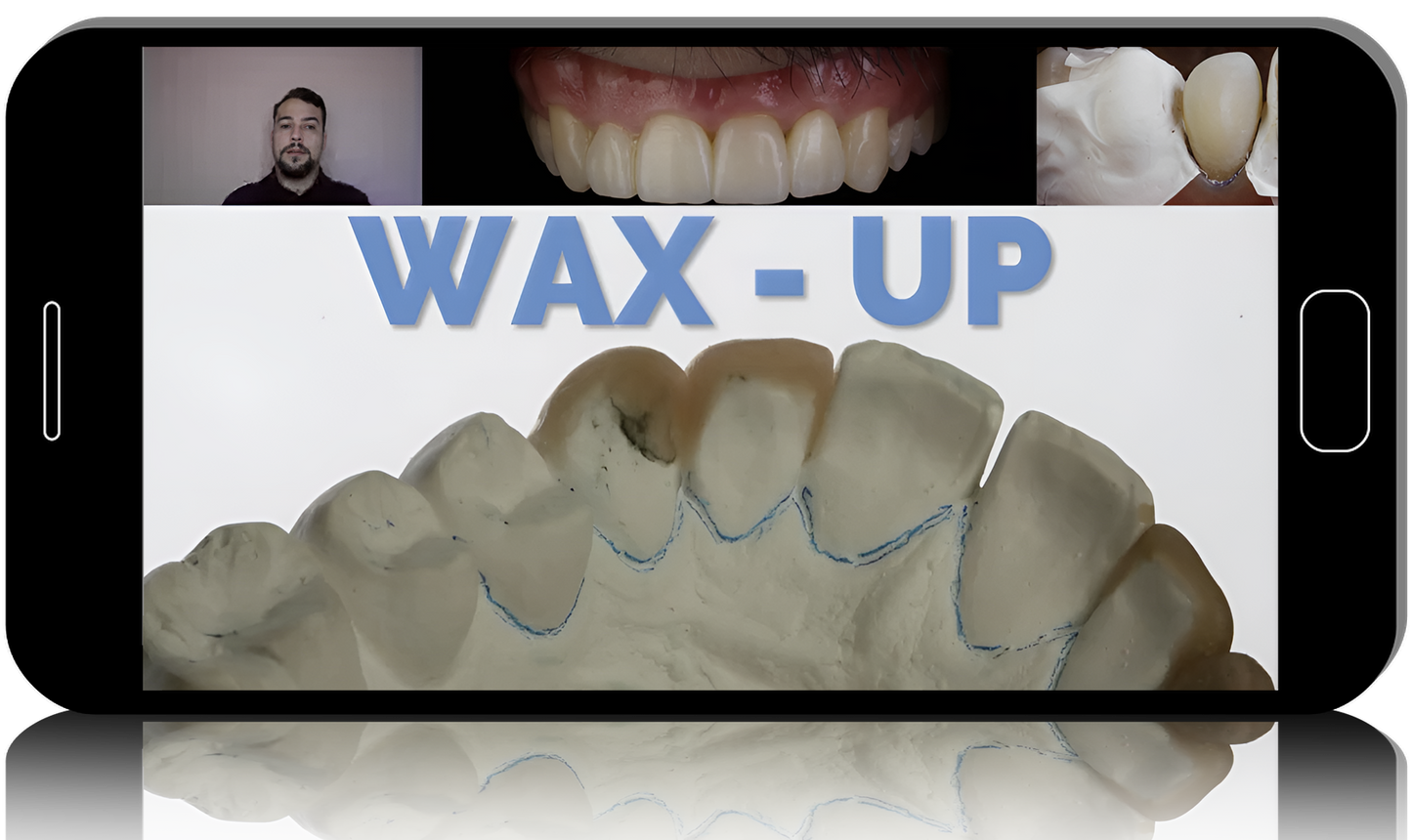 Injectable Technique: Composites Veneers, Comprehensive Online MasterClass 2022