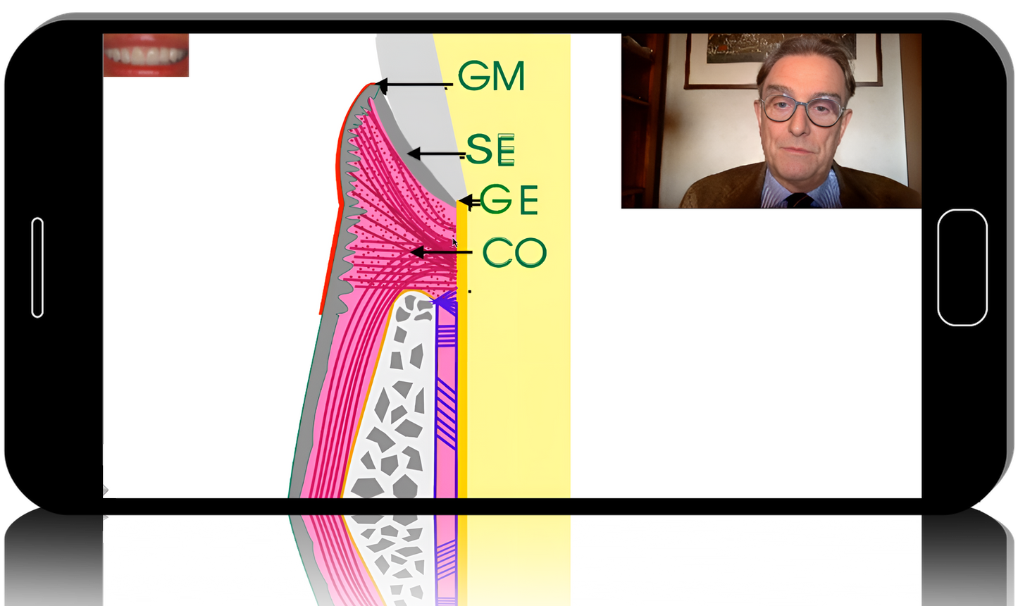 Surgical periodontics: preparation for prosthetics