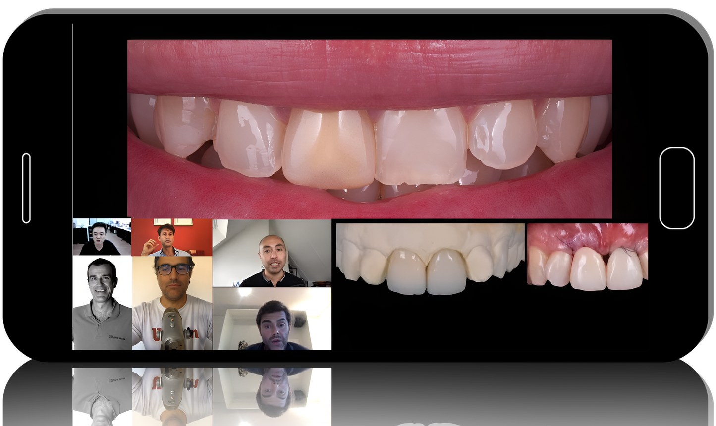 Implant Complications in the Aesthetic Zone