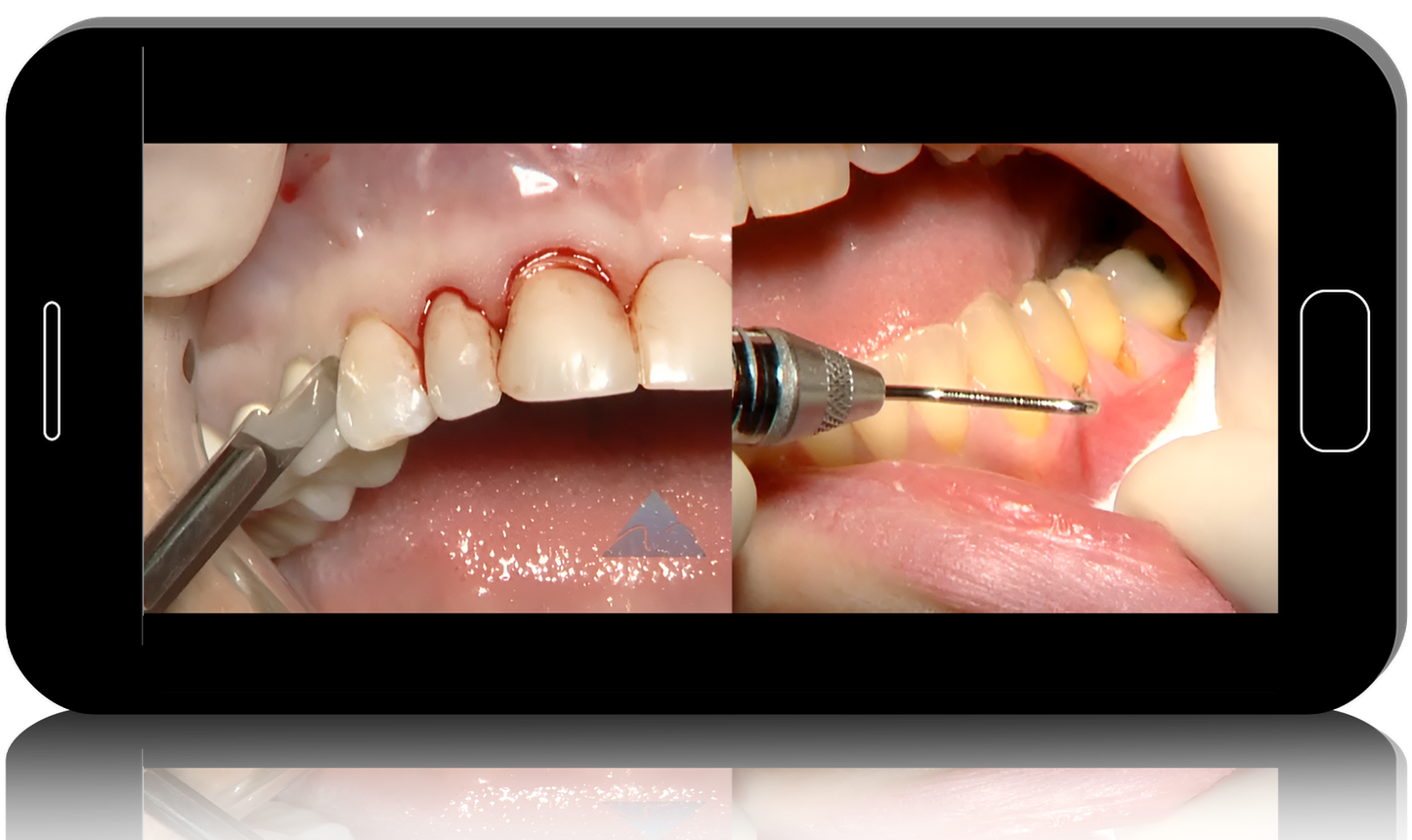 Hard and Soft Tissue Ridge Augmentation and Esthetic Crown Lengthening