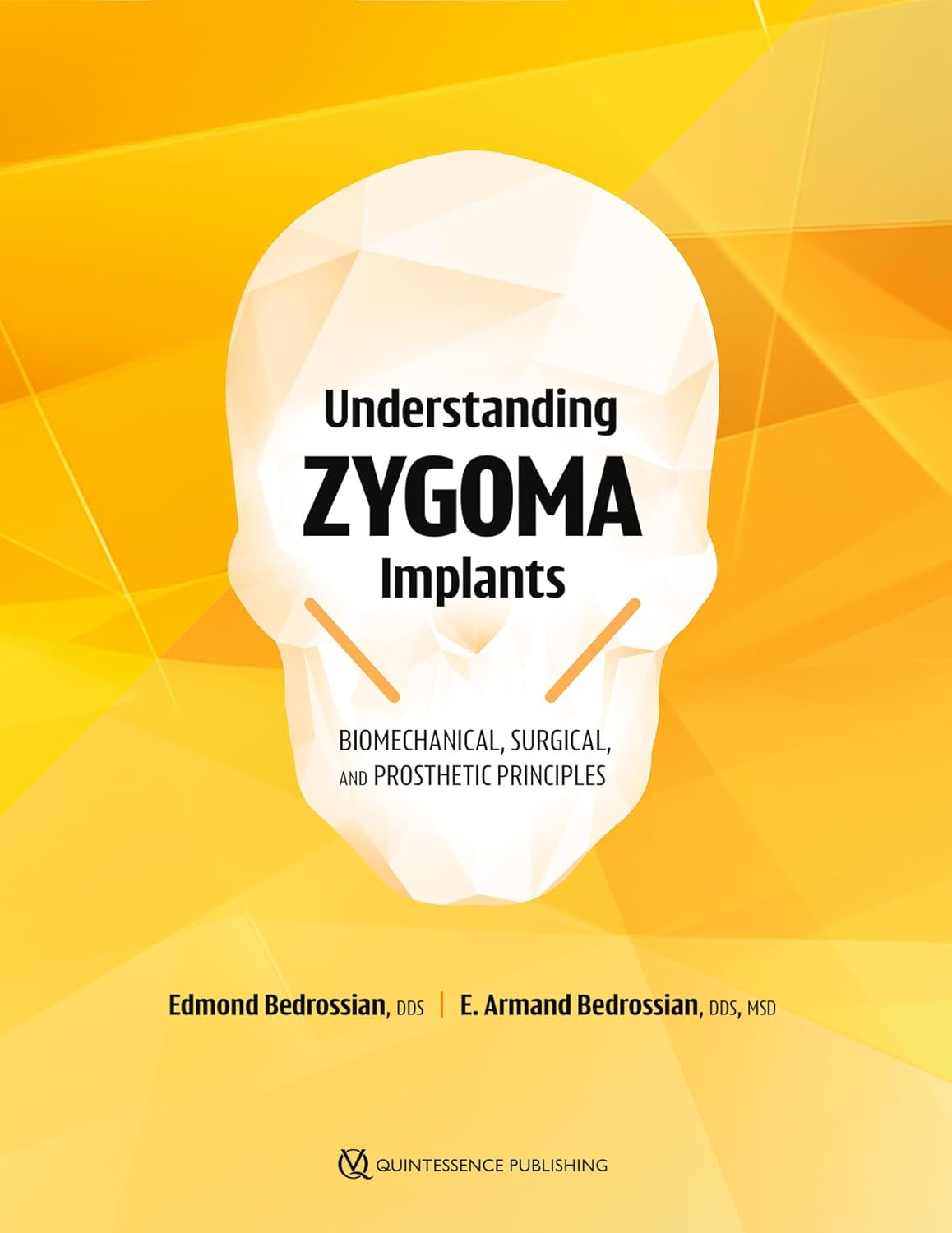 Understanding Zygoma Implants