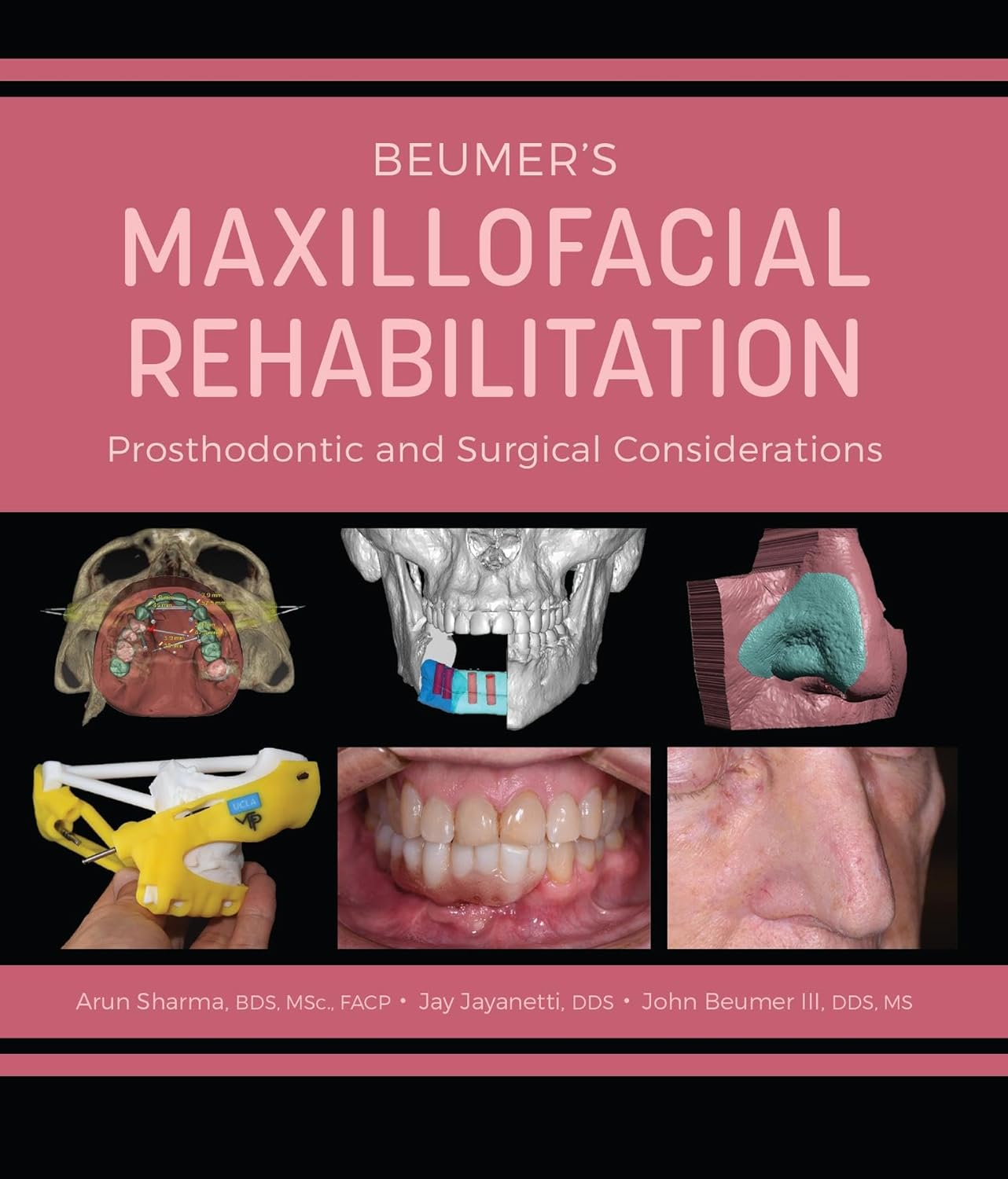 Beumer's Maxillofacial Rehabilitation: Prosthodontics and Surgical Considerations