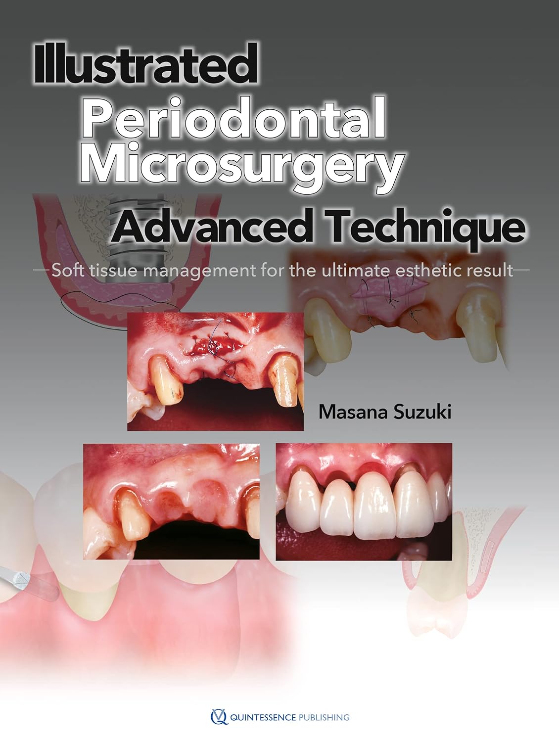 Illustrated Periodontal Microsurgery: Advanced Technique Soft Tissue Management for the Ultimate Esthetic Result (scanned copy)
