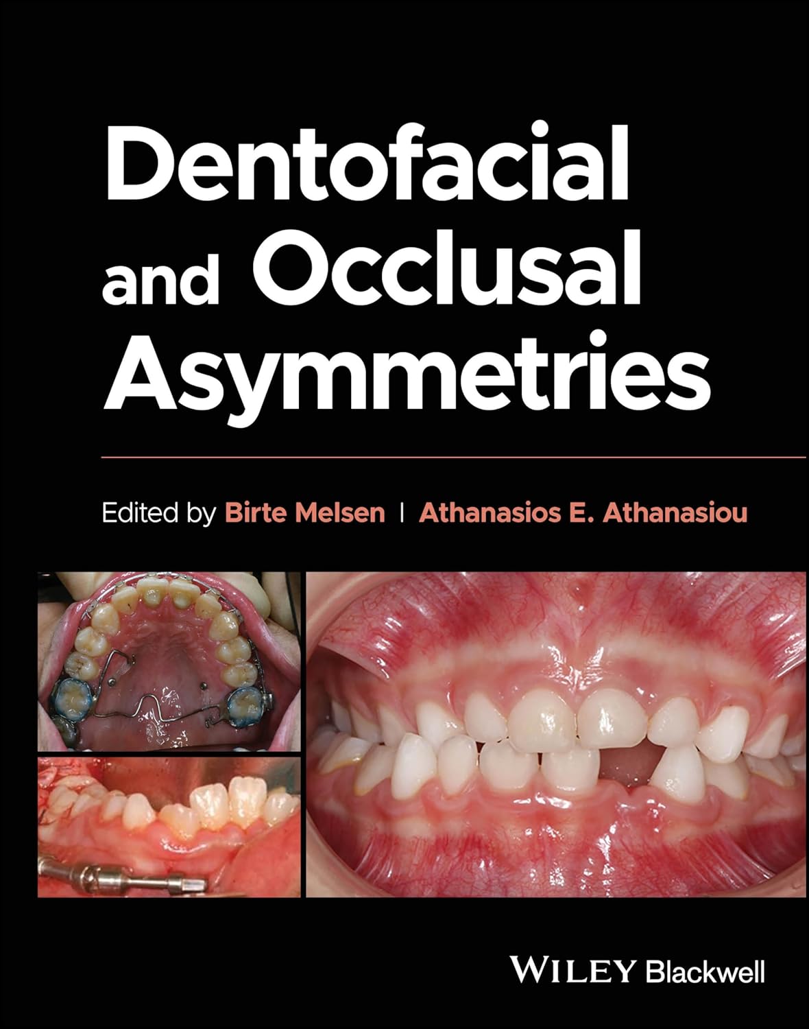 Dentofacial and Occlusal Asymmetries 1st Edition