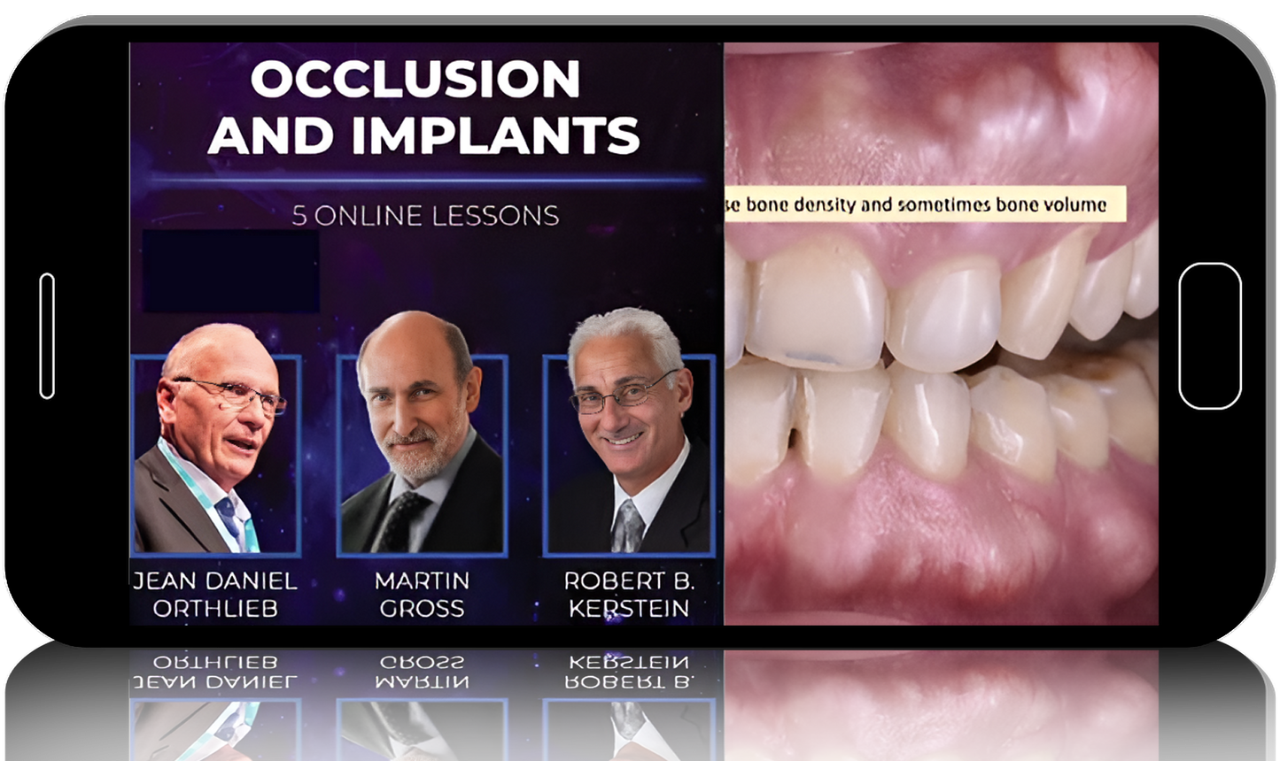 Occlusion and Implants