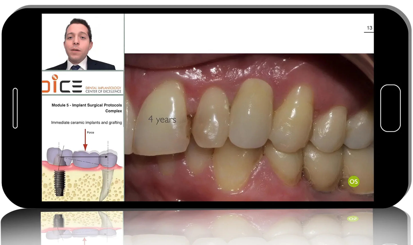Ceramic Implant Application: From Single Tooth to Full Arch