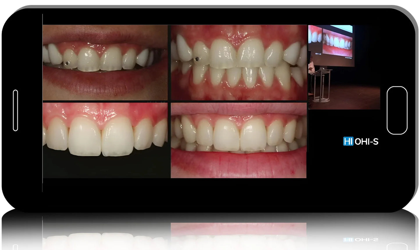 Anterior Veneers: Digital manufacturing protocols for functional and aesthetic restorations