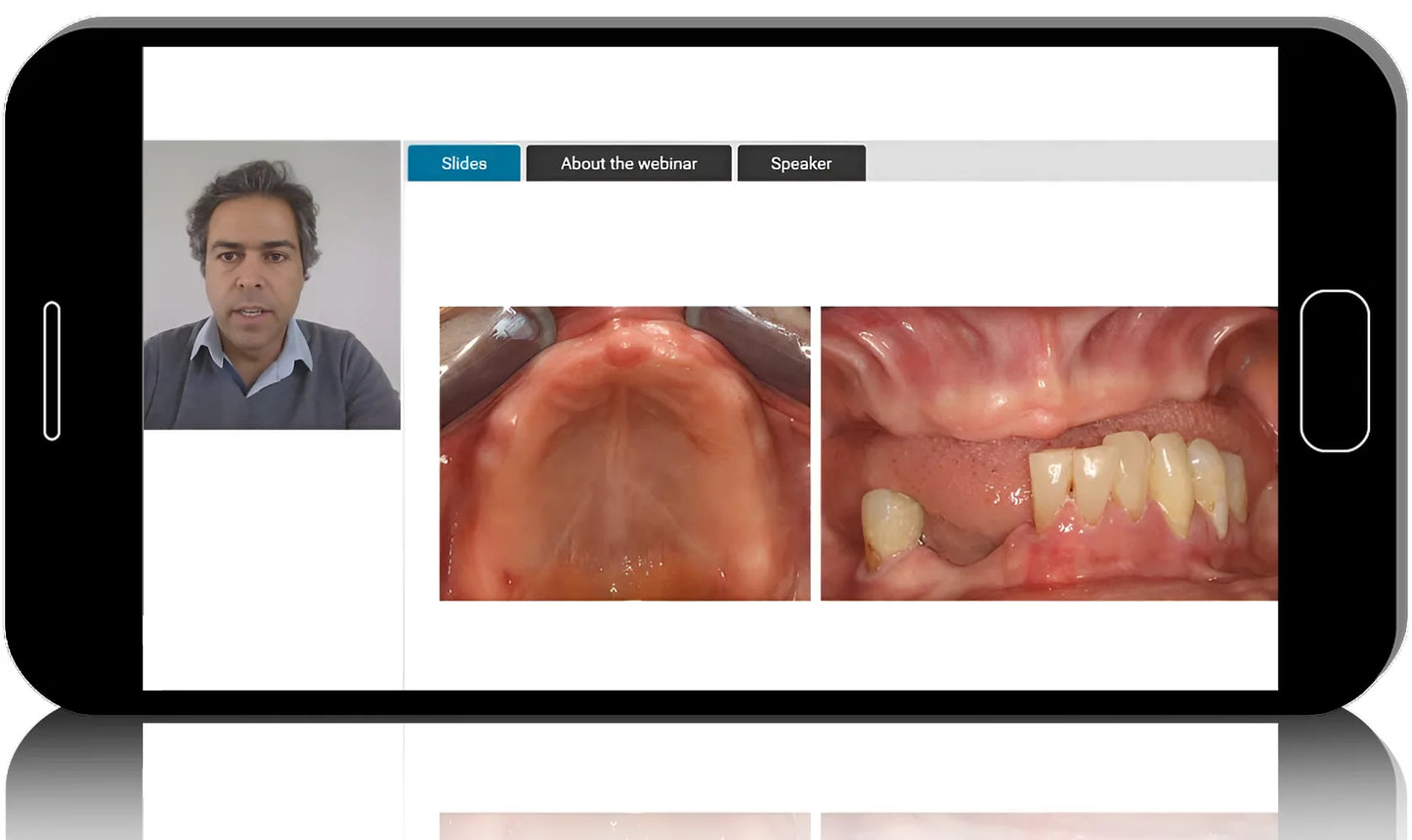 Emerging Trends in Digital Workflows for Surgical Rehabilitation of Completely Edentulous Patients