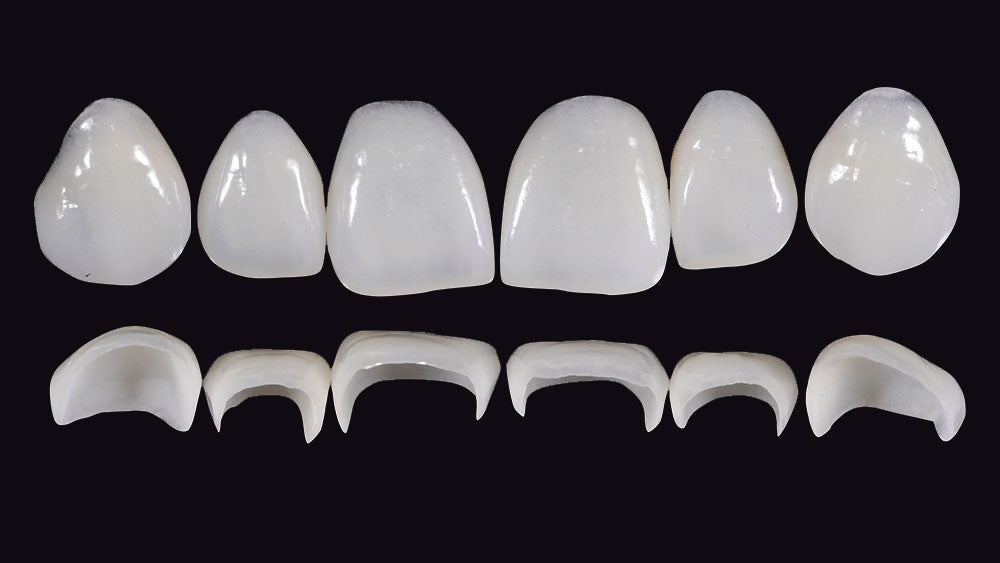 Gidedental Prosthetic Rehabilitation on Natural Teeth