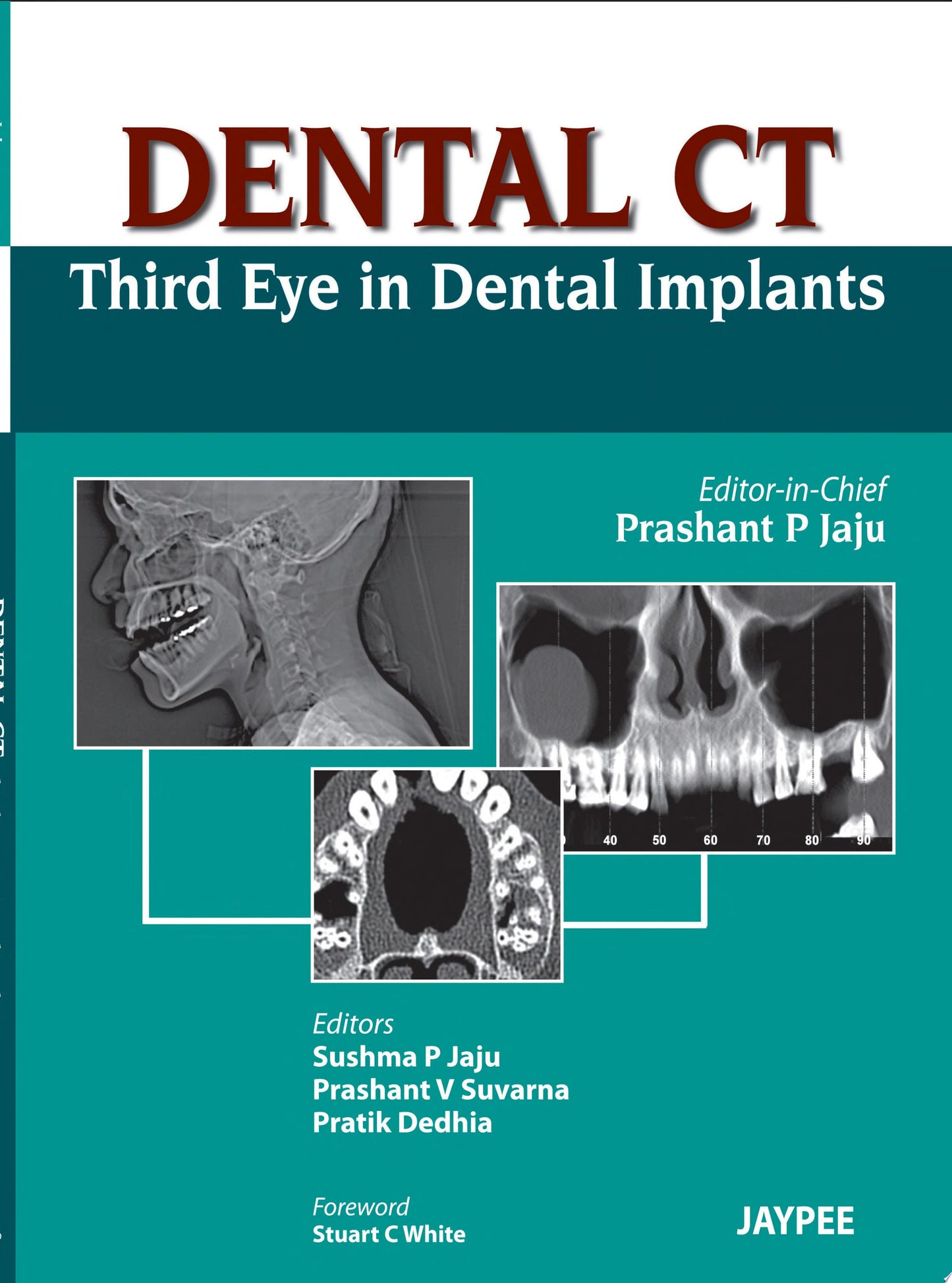 Dental CT Third Eye in Dental Implants