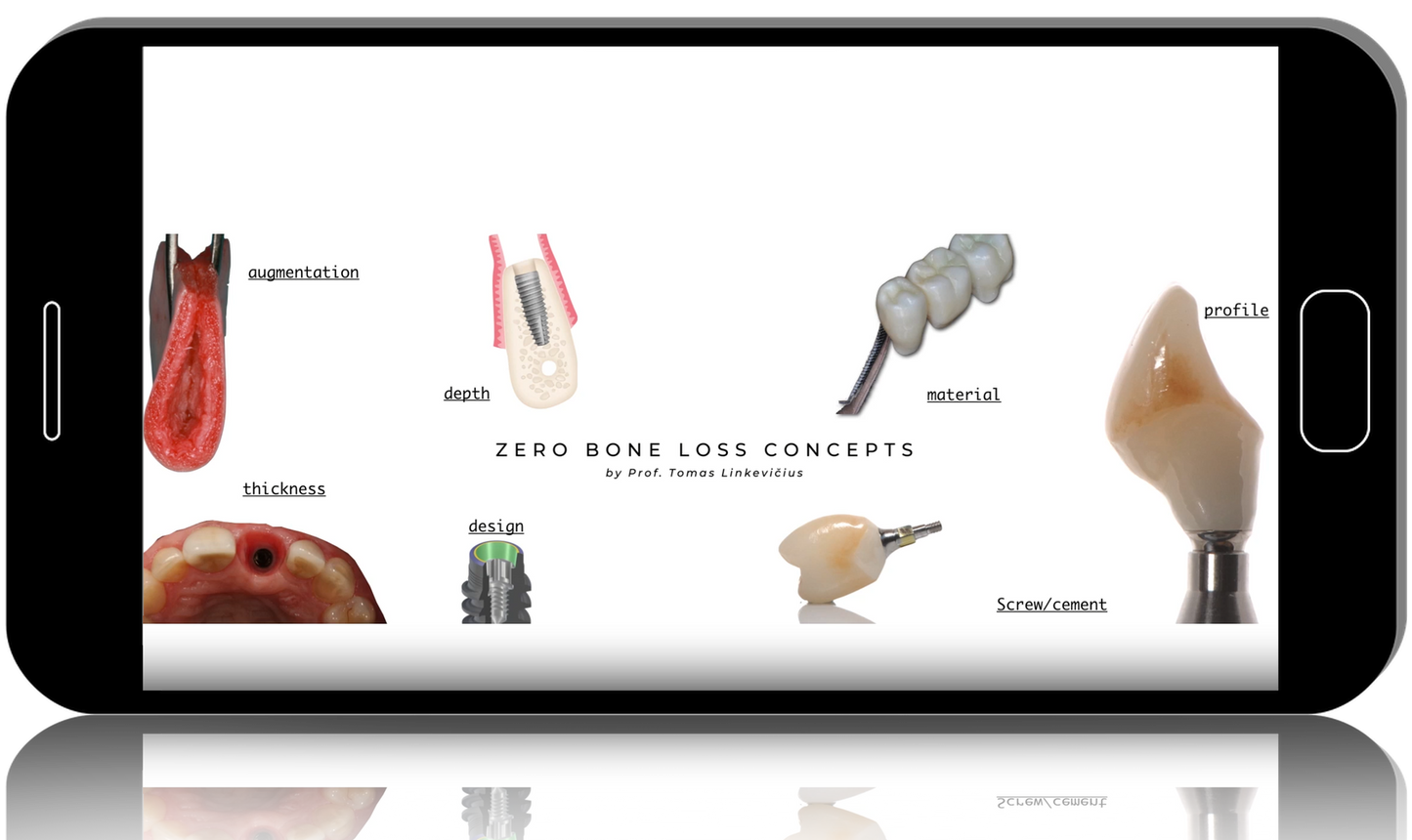 Zero Bone Loss Concepts - How to develop and maintain crestal bone stability