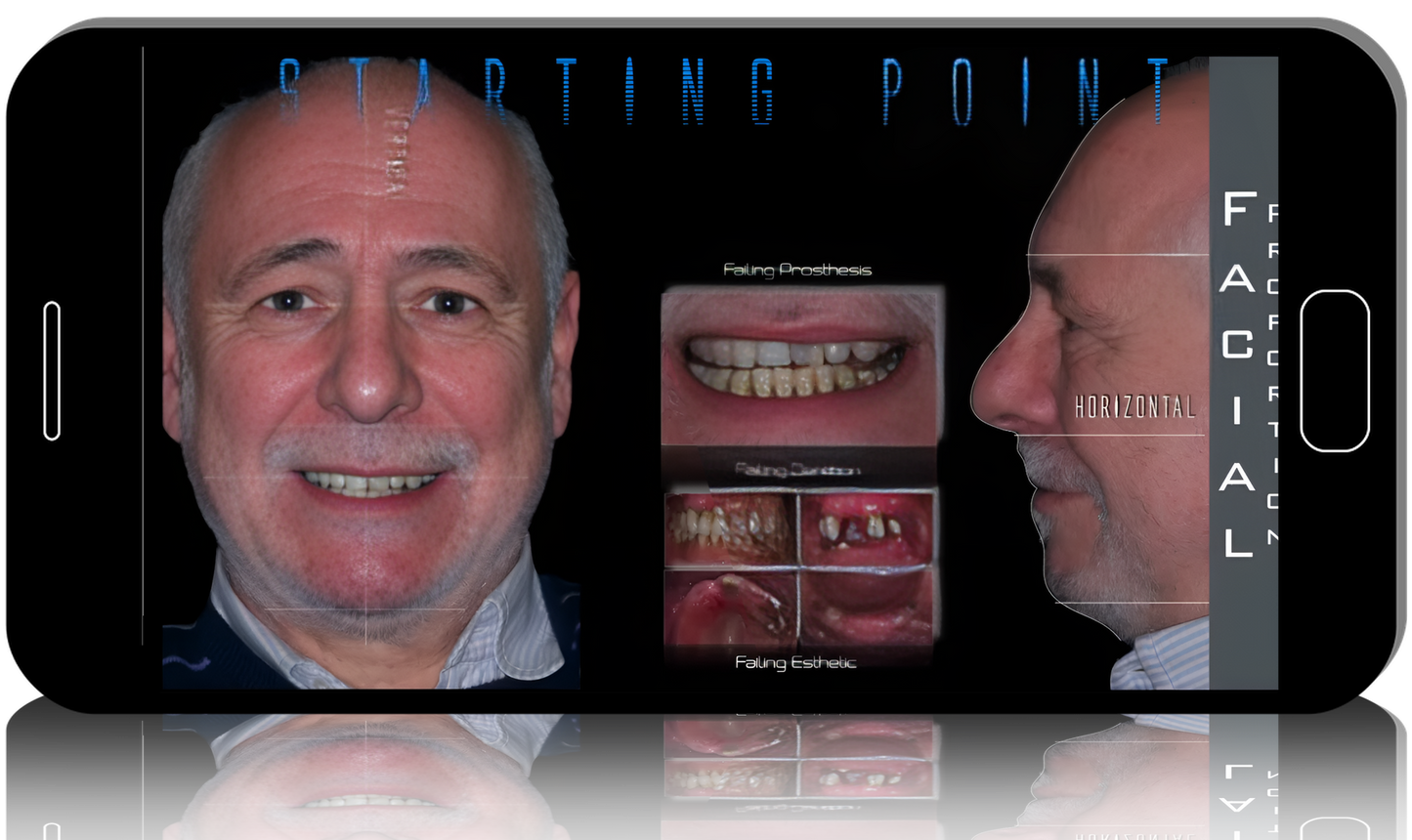 Full-arch rehabilitation. Implantation and prosthetics