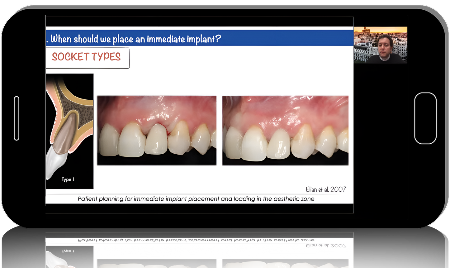 Immediate Implant Placement and Loading: Surgical Protocols