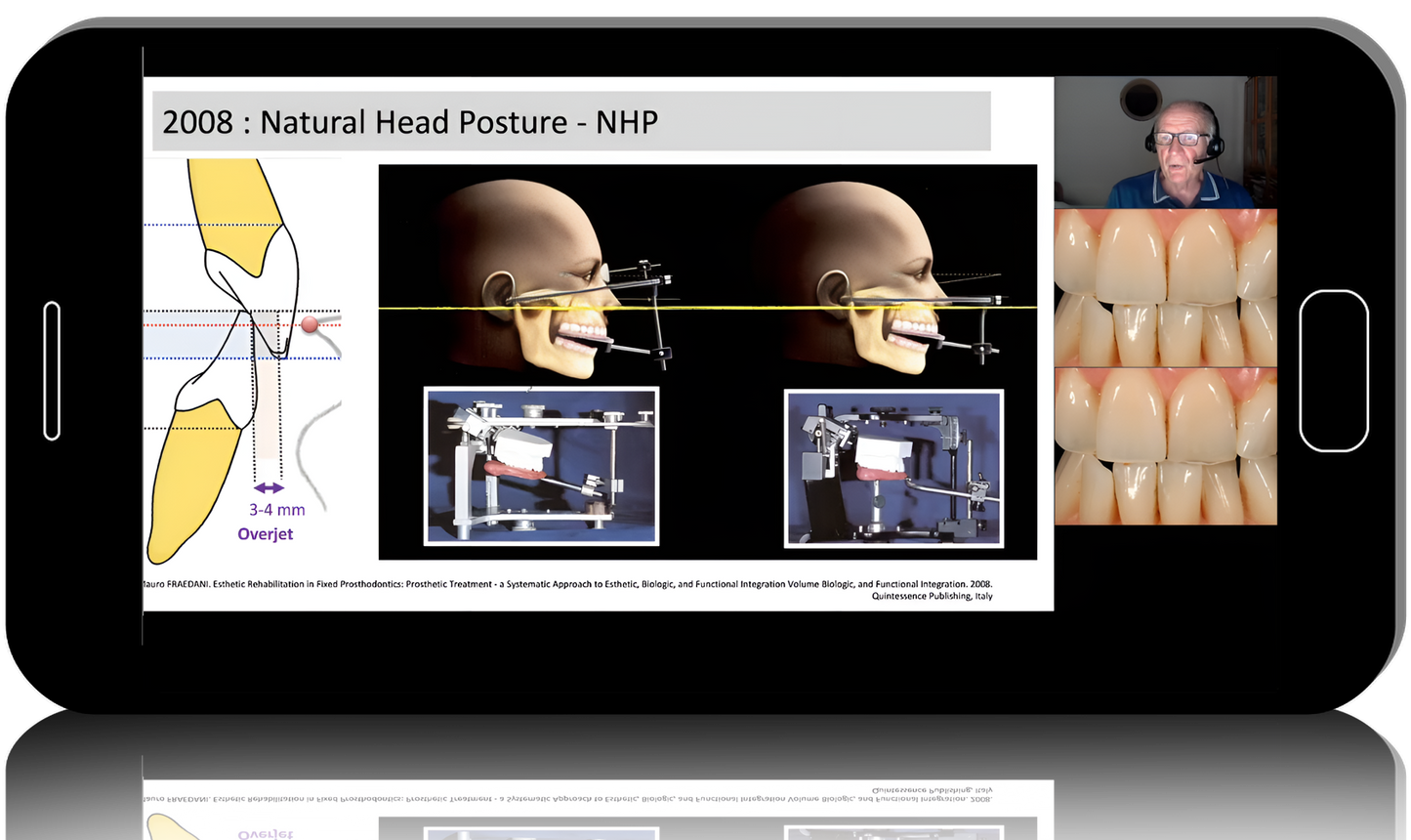 Removable complete dentures and Digital Dentures