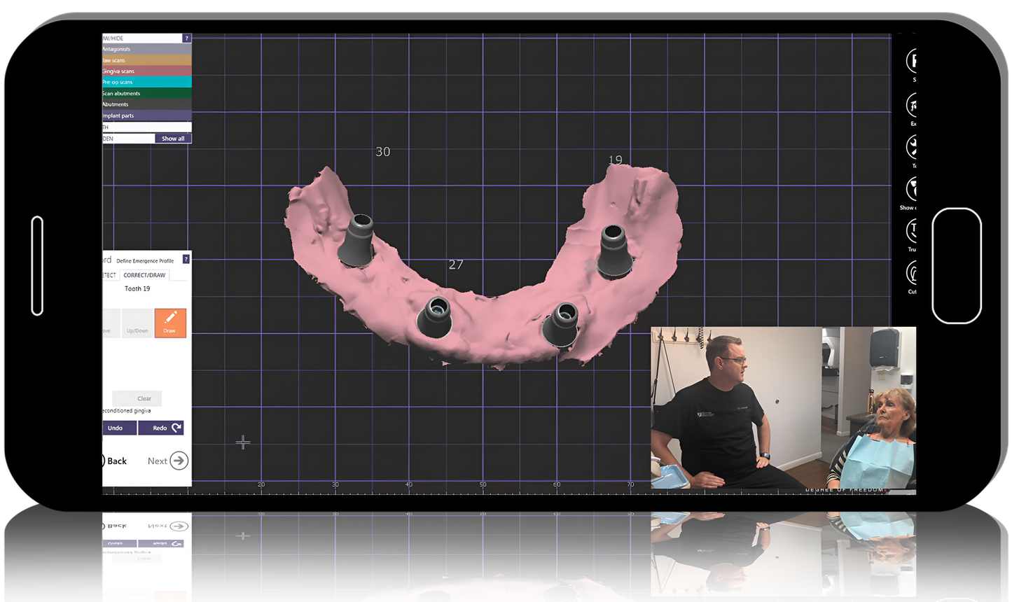 AOX Crystal Ultra Hybrid Restoration – ALL Clinical & Lab Steps Start to Finish