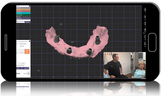 AOX Crystal Ultra Hybrid Restoration – ALL Clinical & Lab Steps Start to Finish