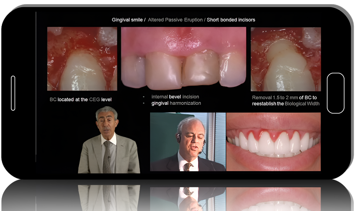 gIDE - The Art and Science of Surgical Crown Lengthening