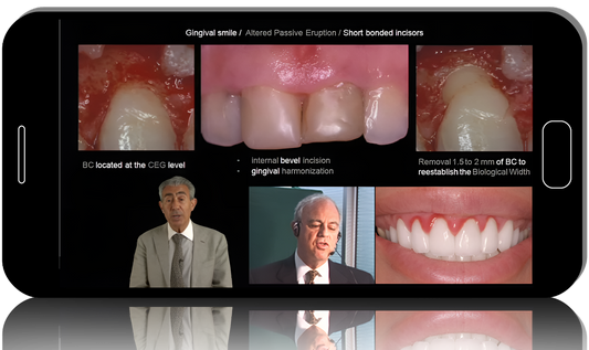 gIDE - The Art and Science of Surgical Crown Lengthening