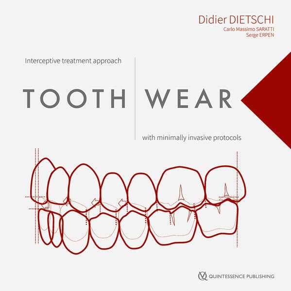 Tooth Wear: Interceptive Treatment Approach With Minimally Invasive Protocols