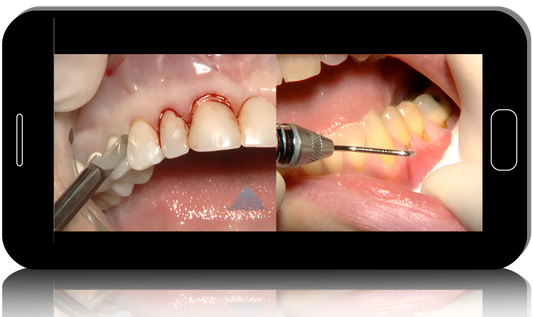Hard and Soft Tissue Ridge Augmentation and Esthetic Crown Lengthening