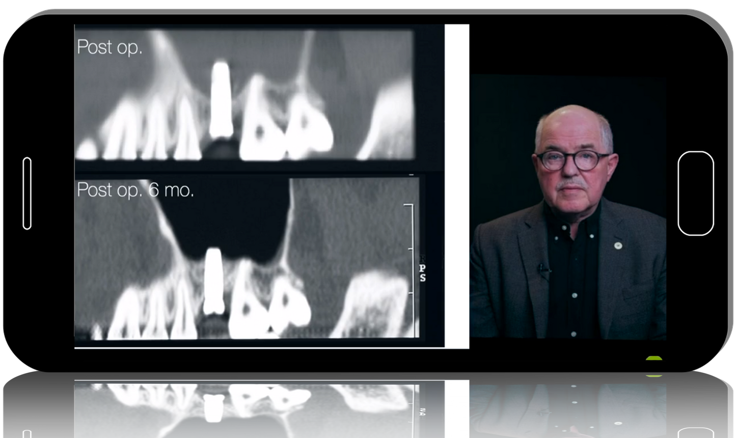 Graftless Lateral Sinus Floor Elevation