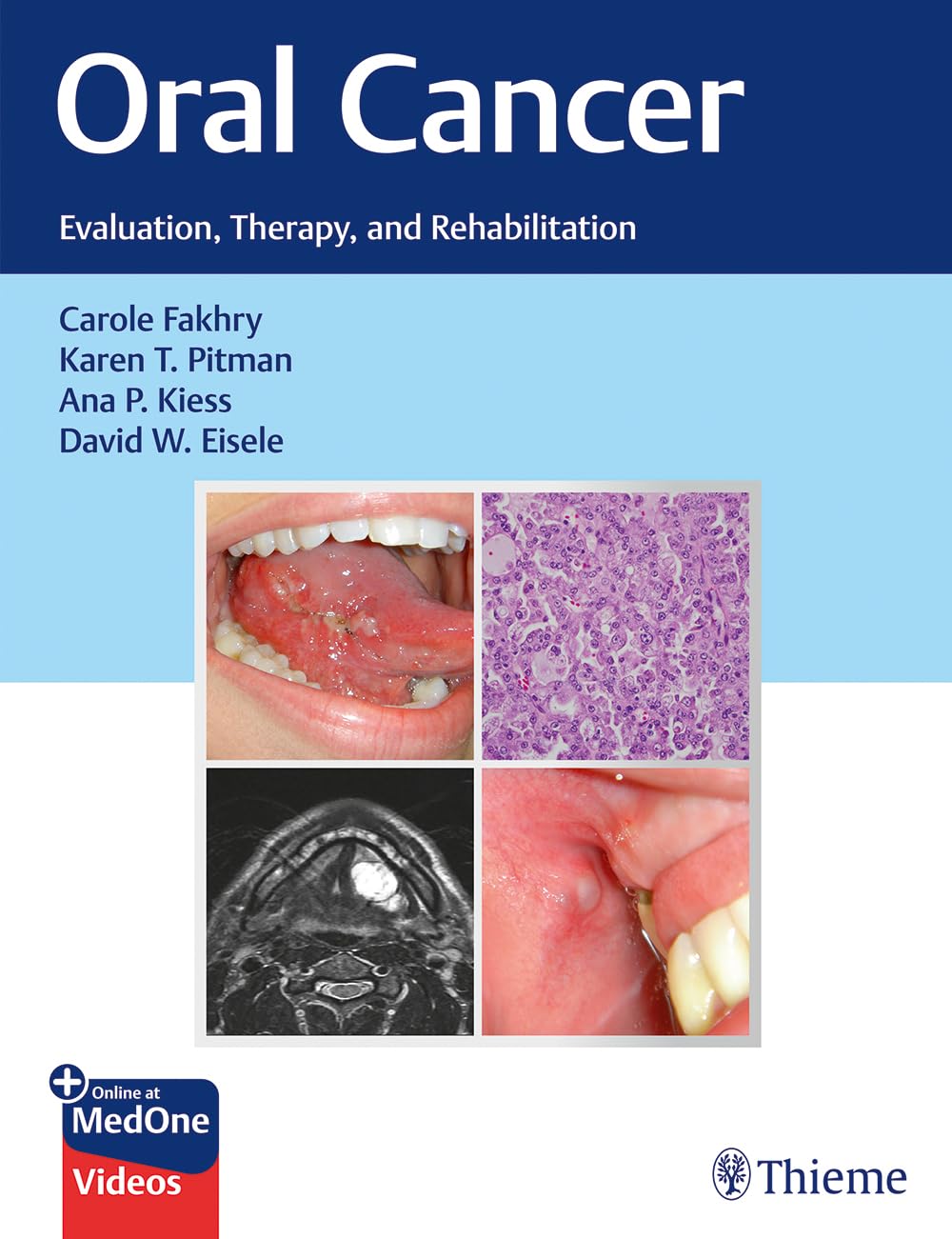 Oral Cancer: Evaluation, Therapy, and Rehabilitation (PDF & Videos)