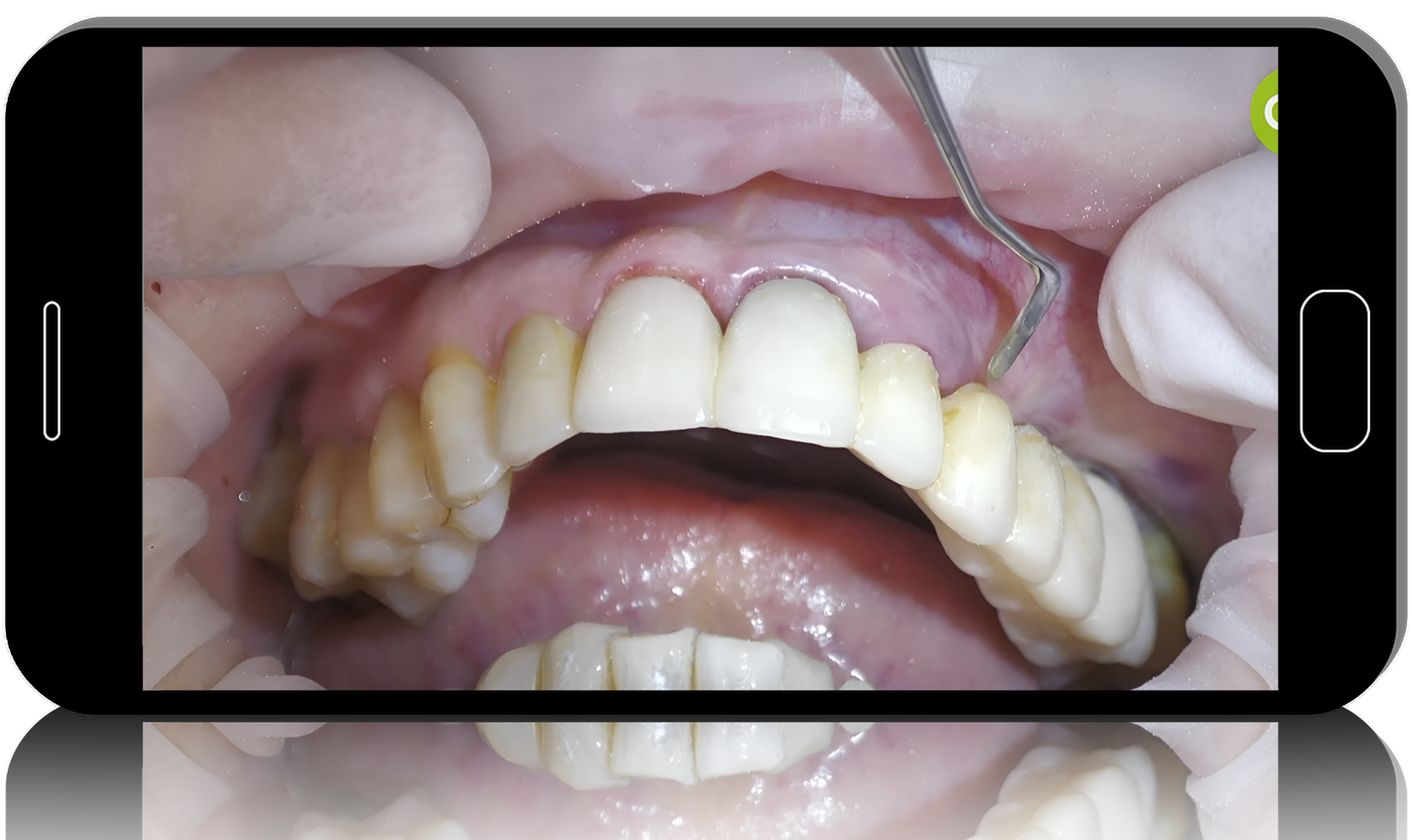 Key Surgical and Prosthetic Considerations for Soft Tissue Management in Immediate and Delayed Implantology