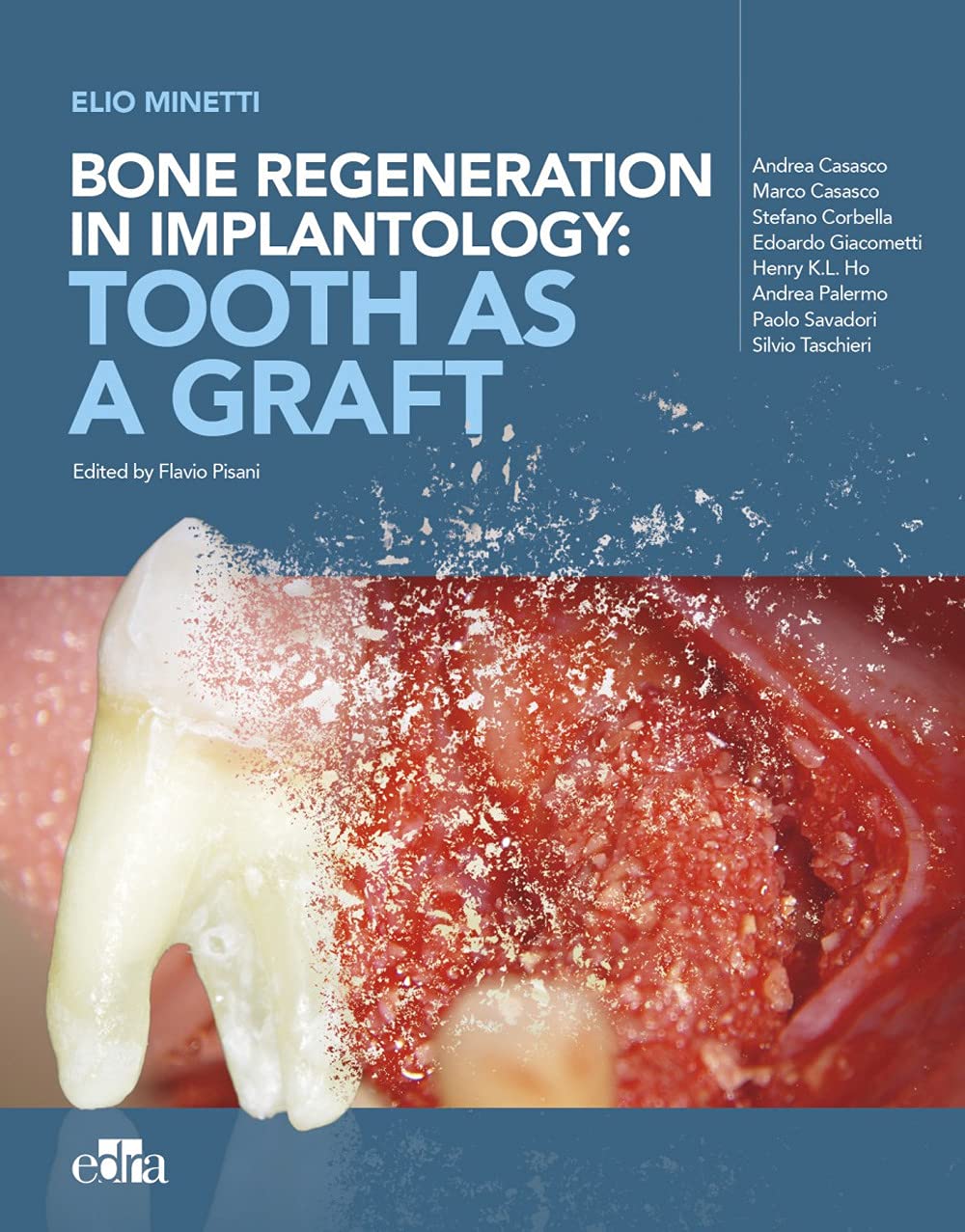 Bone regeneration in implantology:tooth as a graft