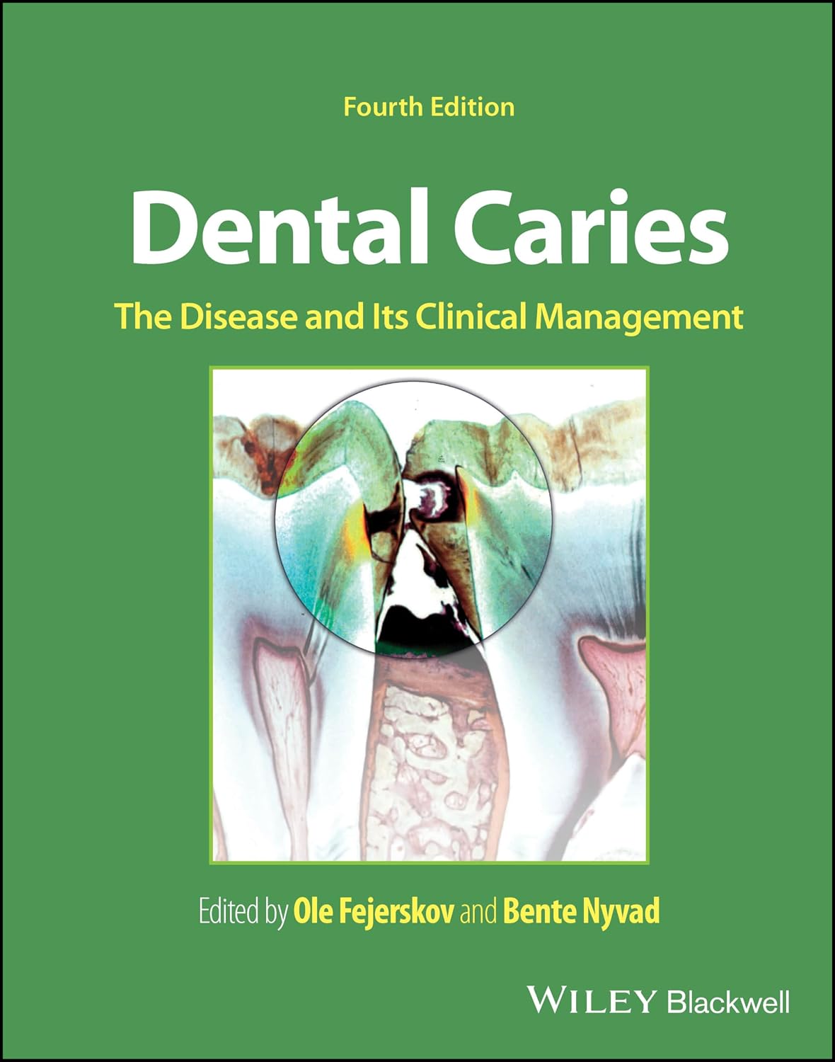 Dental Caries: The Disease and its Clinical Management (PDF) 2025