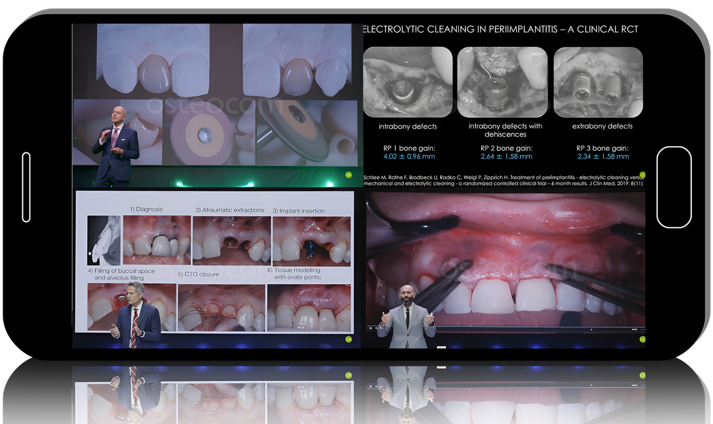 Implants in the Aesthetic Zone: From Successful Placement to Failure Management 2025