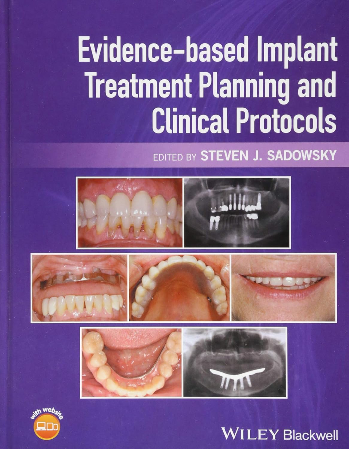 Evidence-based Implant Treatment Planning and Clinical Protocols 1st Edition