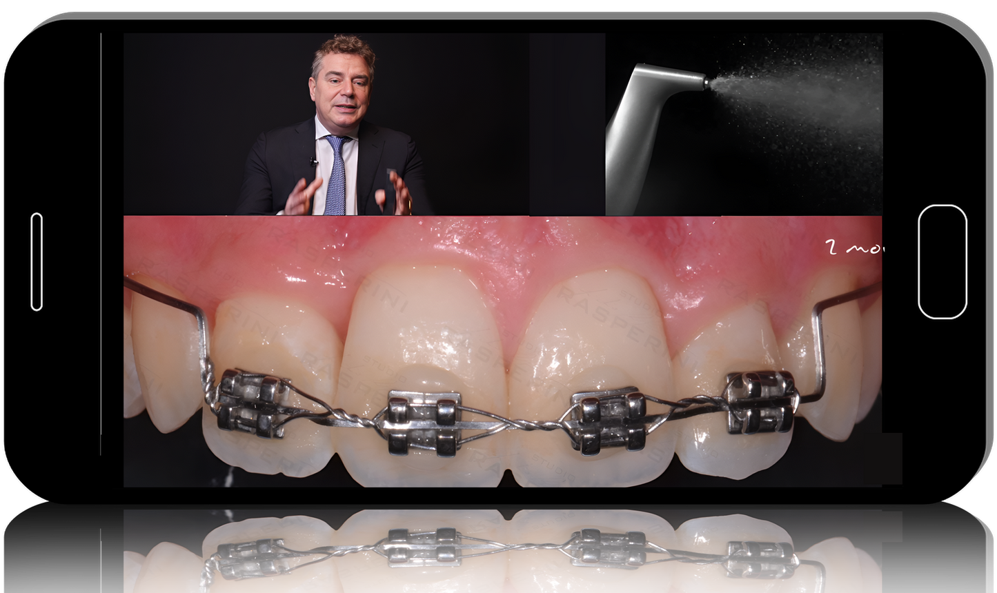 How To Save Teeth With Periodontal Disease