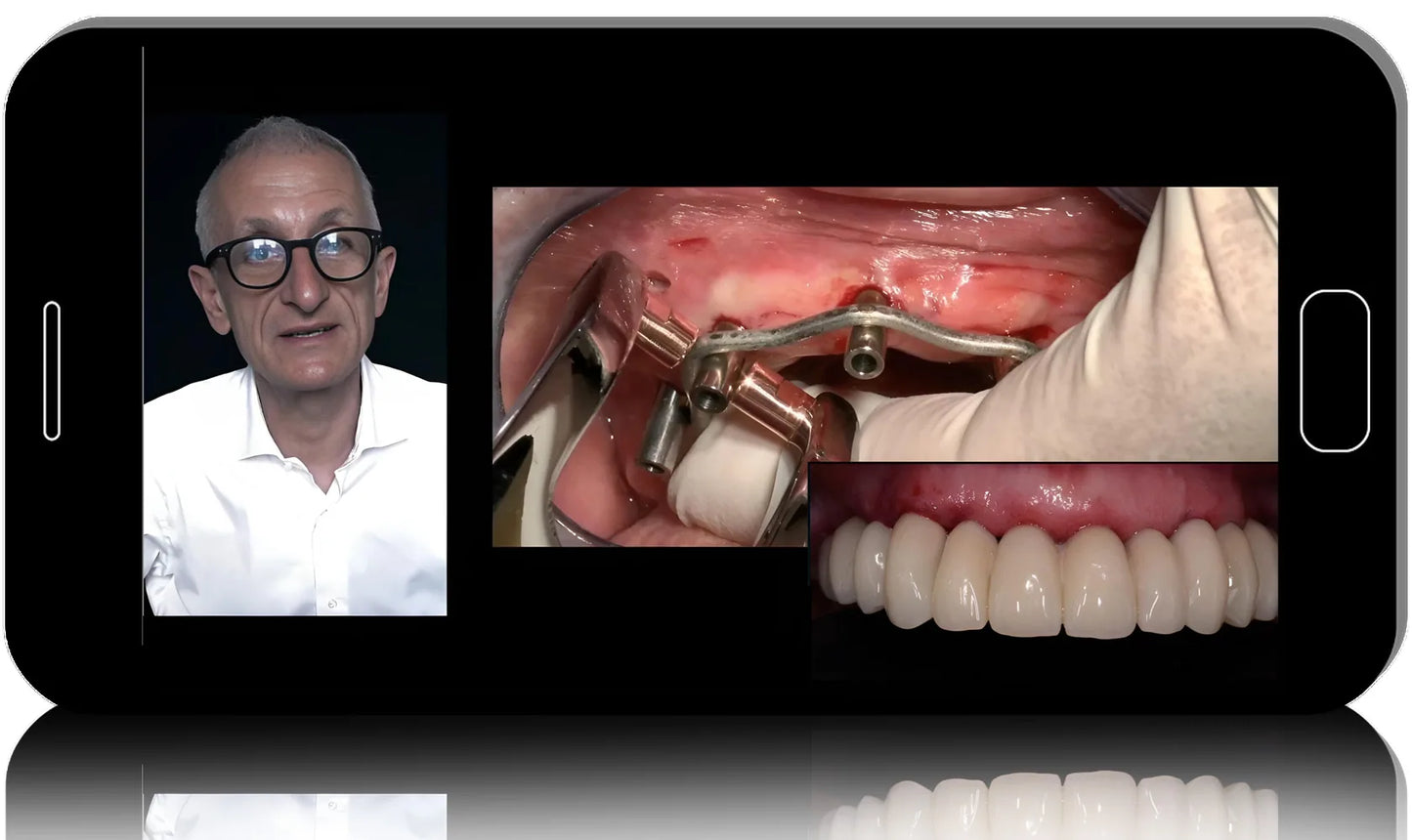 Degidi MasterClass Immediate Loading