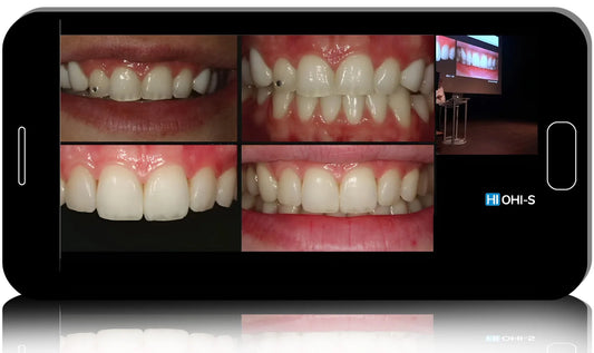 Anterior Veneers: Digital manufacturing protocols for functional and aesthetic restorations