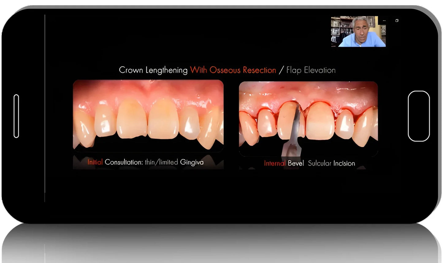 Crown Lengthening From Conventional to Digital Approach