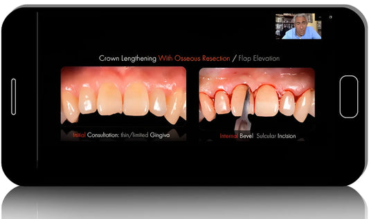 Crown Lengthening From Conventional to Digital Approach