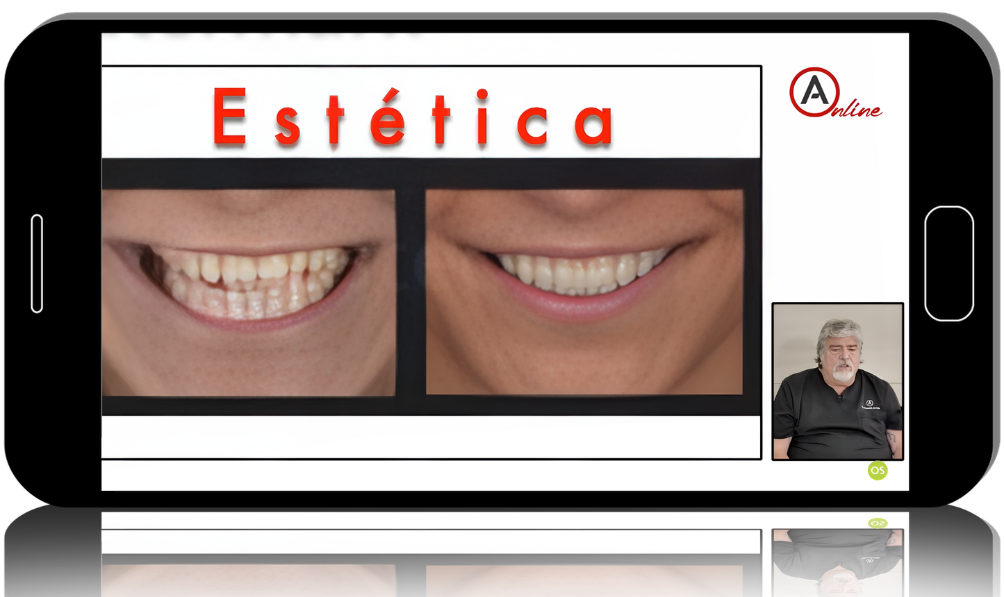 Direct Anterior Composite Restorations