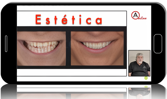Direct Anterior Composite Restorations