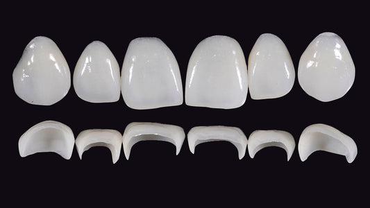Gidedental Prosthetic Rehabilitation on Natural Teeth