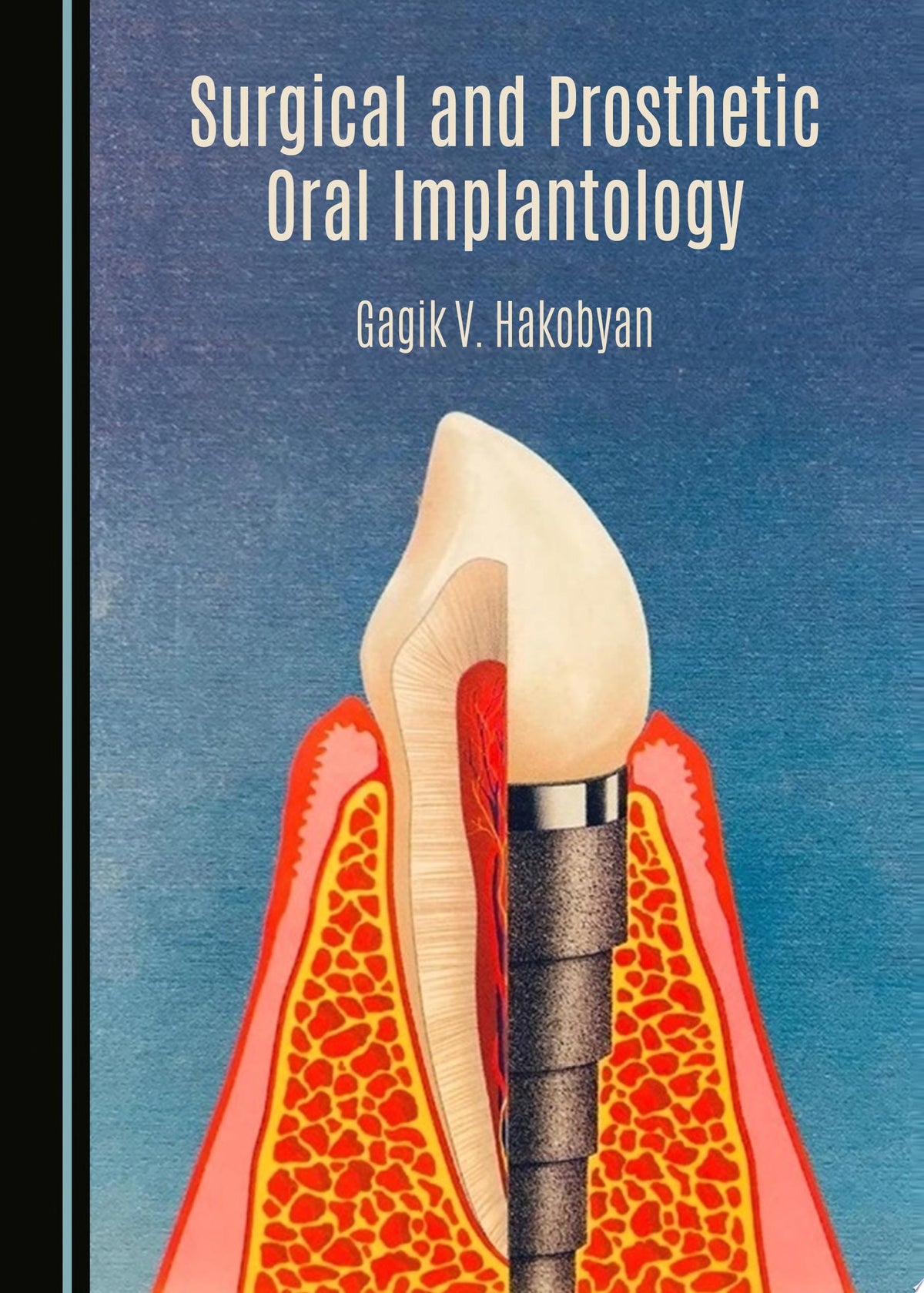 Surgical and Prosthetic Oral Implantology