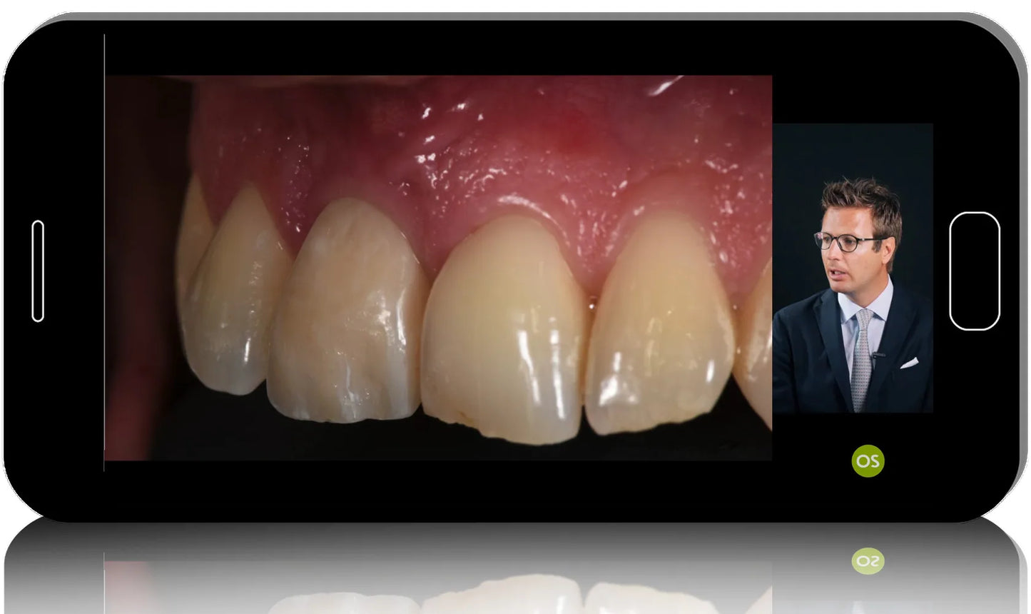 Post-Extraction Implants: Immediate implant placement in the esthetic zone