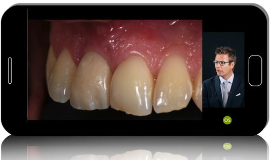Post-Extraction Implants: Immediate implant placement in the esthetic zone