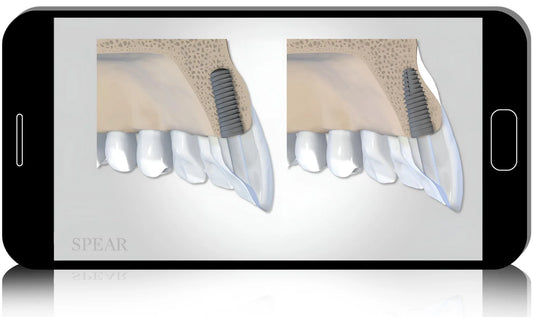 Mastering Full Arch Implant Dentistry: A Digital-to-Delivery Approach