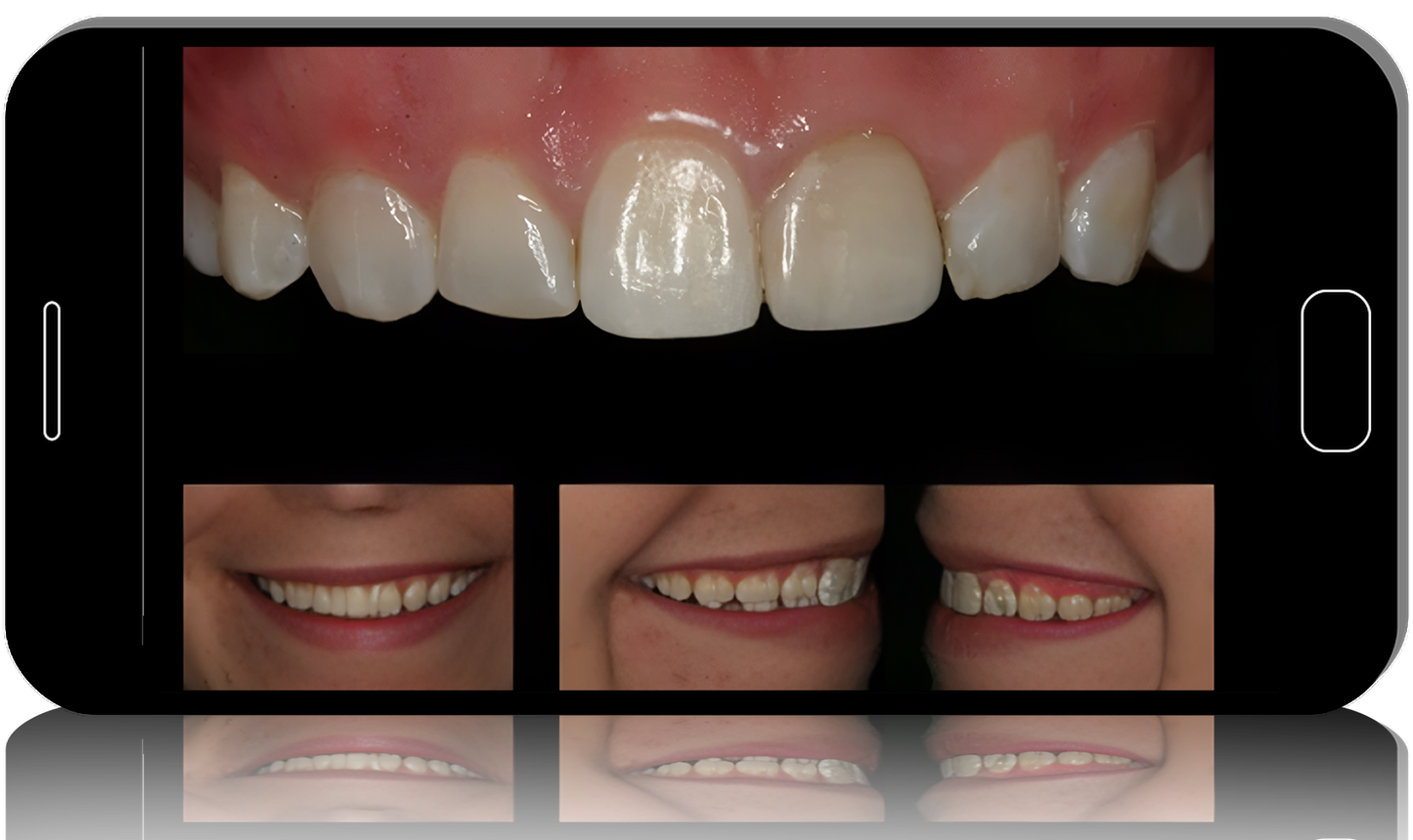 Surgical Master: Esthetic and Functional Crown Lengthening