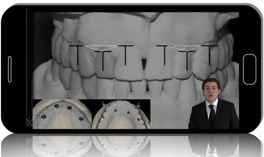 gIDE - Edentulous Patient Implant Placement and Restoration