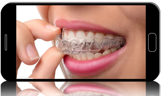 A one year program on aligner therapy