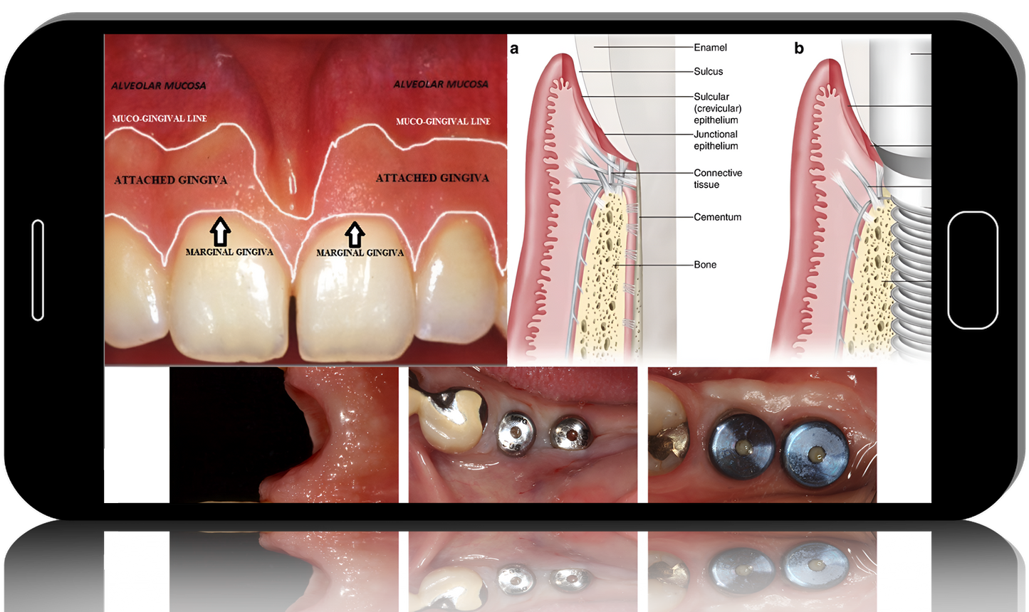 Soft Tissue Management for Implants, The Complete Course